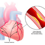 Coronary Artery Blockage | Savi Homeopathy