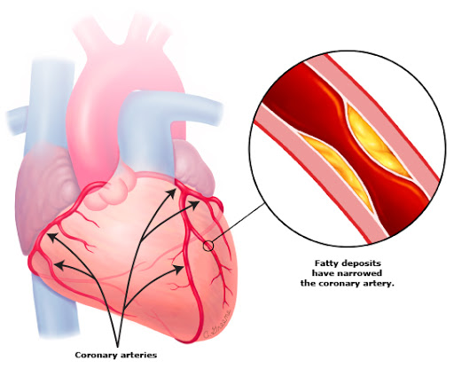 Coronary Artery Blockage | Savi Homeopathy