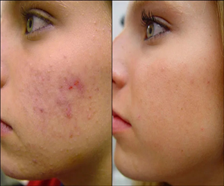 acne vulgaris homeopathy remedy