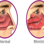 Allergic Rhinitis cure by Savi Homeopathy