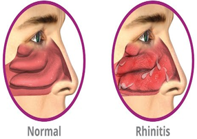 Allergic Rhinitis cure by Savi Homeopathy