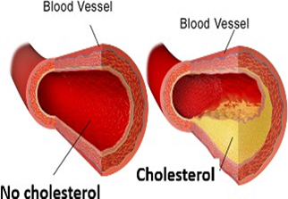 High Cholesterol - Symptoms and Causes - Savi Homeopathic Clinic