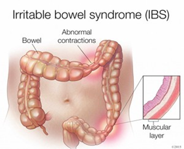 Best Treatment for IBS