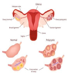 Common signs and symptoms of PCOD /PCOS