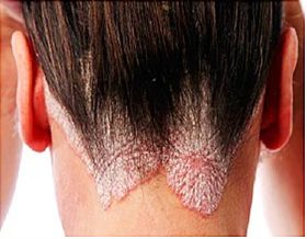 homeopathy treatment for psoriasis