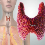 Homeopathy permanent recovery for Thyroid Disorders