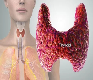 Homeopathy permanent recovery for Thyroid Disorders