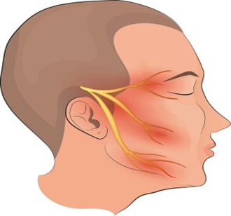 Effective Homeopathic Treatment for Trigeminal Neuralgia