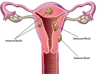 Best Homeopathic Treatment of Uterus